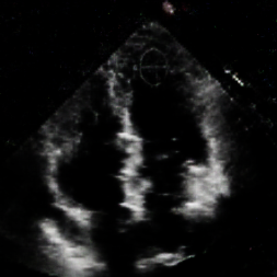 Echocardiogram